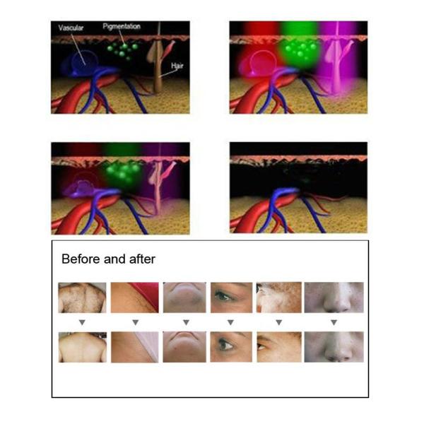 лазер RF удаления волос лазера 480nm 530nm DPL Resurfacing машина