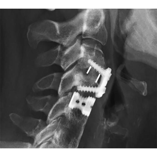 Durable Cornerstone Peek Cage Perforated Structure For Bone Ingrowth / Throughgrowth