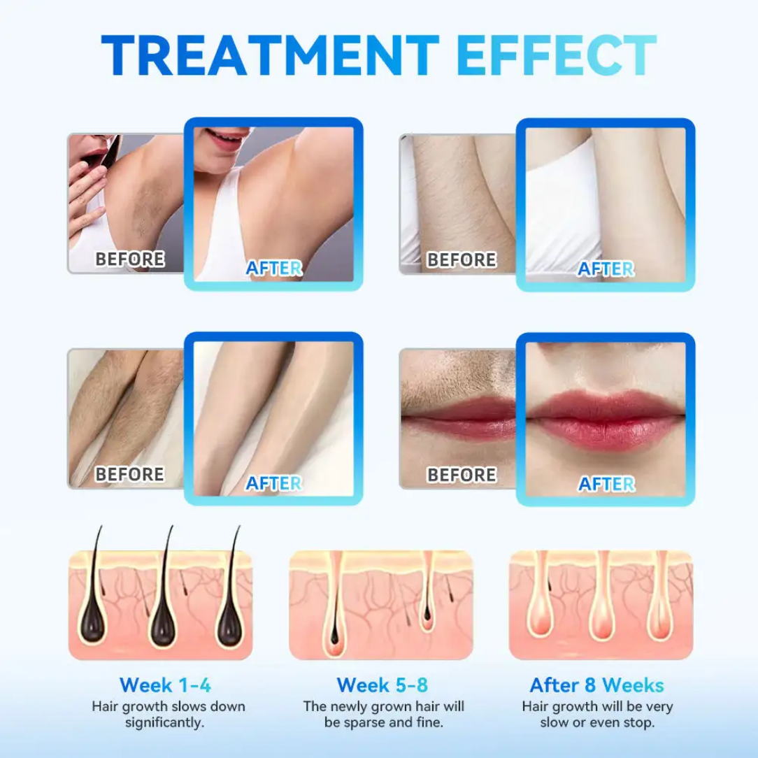 Full Body Hair Removal Machine 4000W Standing Diode Hair Removal Laser System