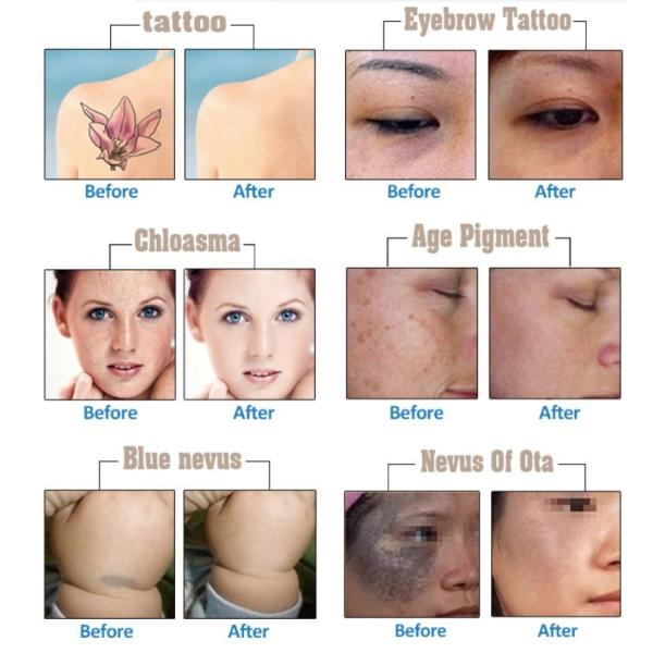 Épilation laser à diode portative 808nm Picosecond Machine d'épilation de tatouage