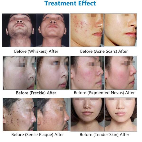 Effective SHR IPL Beauty Equipment For Hair Removal / Skin Rejuvenation