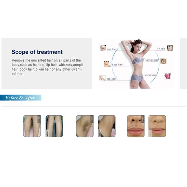 Nunway 2016 hot promotion 808nm diode laser inmotion hair removal skin rejuvenation machine CE FDA approved