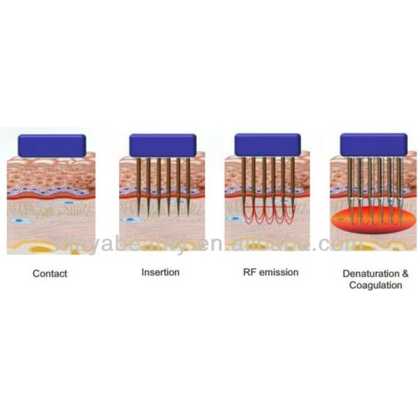 fractional rf needle machine for home use for skin lifting