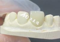 Veneur EMAX durable et esthétique La solution parfaite pour les restaurations de porcelaine