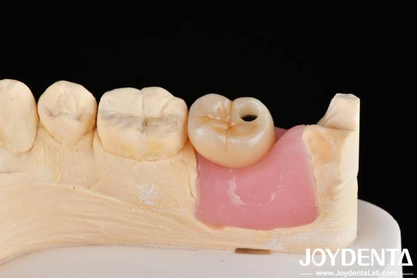 Internal Hex Titanium Dental Implants Precision Machining With Zero Angulation