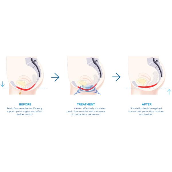 Rectus Abdominis 13 Tesla EMS Muscle Stimulator Machine PRIVATE THERAPY CHAI