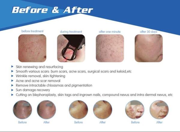 newest vertical 10.4 inch touch screen Laser Resurfacing Machine Fractional Vaginal CO2 Laser Equipment