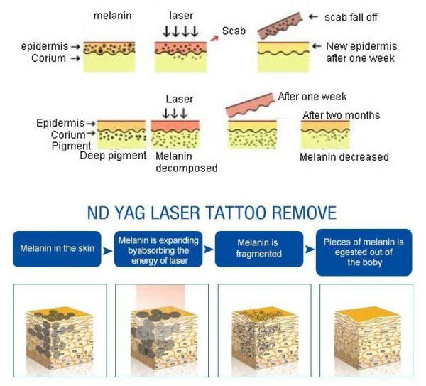 Q Switched Nd Yag Laser Tattoo Removal Machine Zeus Mode 1064nm / 532nm Wavelength