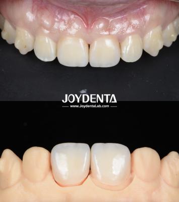 Lightweight Smooth Surface Zirconia Dental Bridges For Implant Supported Restorations