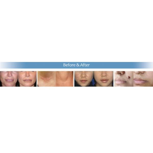 Машина лазера вертикального СО2 Рф дизайна частичная с влагалищной затягивая функцией