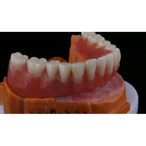 Ivoclar Digital Dental Implant Bar Denture with Attachments Full Acrylic Denture Titanium Implant Supported Dentures
