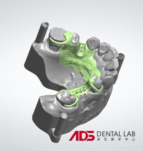 ADS Dental Lab Partial Metal Frame Denture Framework Fabrication