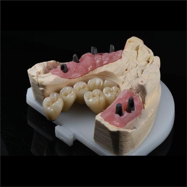Cad Cam Implant PFM Crown Bridge Dental Medical Grade Adhesive