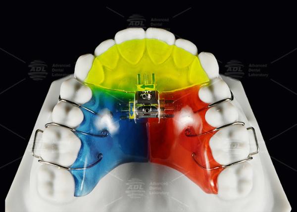 Stainless Steel Acrylic Screw Expander Orthodontic Treatment Removable