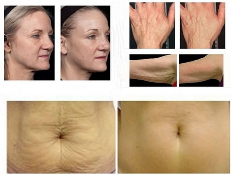 HOT SELLING!!! most effective RF thermage equipment for skin refreshing and rejuvenation