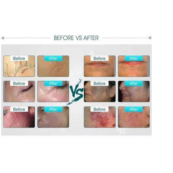 Picosure / Nd Yag Laser Tattoo Removal Machine Portable  Type With Touch Screen