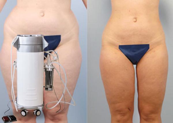 Fat / Cellulite Reduction Power Assisted Slimming Beauty Equipment With Oil Free Vacuum Pump
