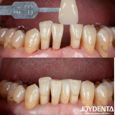 Natural Shape Ceramic Maryland Bonded Bridge Dental Restorations Excellent Aesthetics