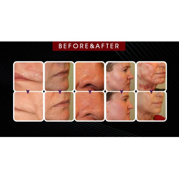 кожа лазера СО2 машина/50В красоты лазера 10600нм частичная Ресурфасинг