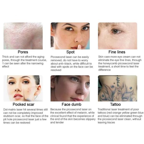 Hot Sale As60 Picosecond Nd Yag Laser Tattoo/Pigment/Eyebrow /Freckle Removal Beauty Salon Machine