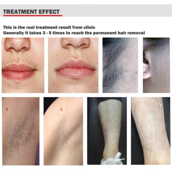 1200 Watt Diode Laser Hair Removal Machine Big Spot Zied 15 * 30 Mm