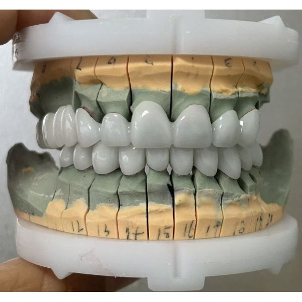 Full Zirconia dental bridge for high strength and durable dental restoration