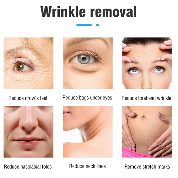 Переносной 22d Max Hifu Machine с Rf Lipo для лифтинга лица и натягивания кожи тела