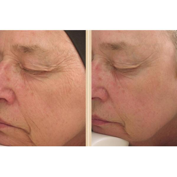 Juvederm смотрит на заполнитель Hyaluronic кисловочные дермальные извлекают морщинки
