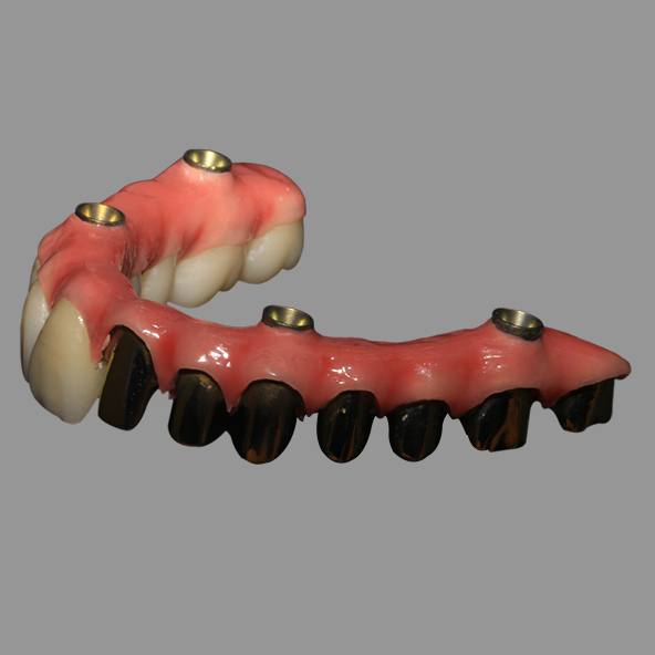 Dental Implant Lab | Class 2 Hybrid Malong Full Arch AOX Implant Bridge Titanium Bar With Full Solid Zirconia