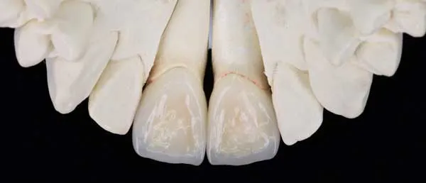 Zirconia Dentures Teeth Dental Lab Single Crown Anterior Posterior Dental Restoration