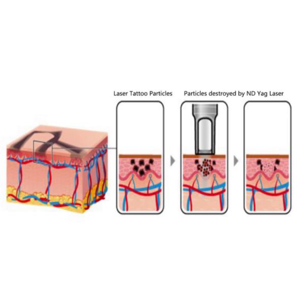 Q-Beam Plus™ Nd:Yag Lasers Tattoo Remover