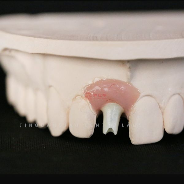 Custom Dental Implant Screw Retained Crown Hybrid Dentures Zirconia Angled Abutment China Lab