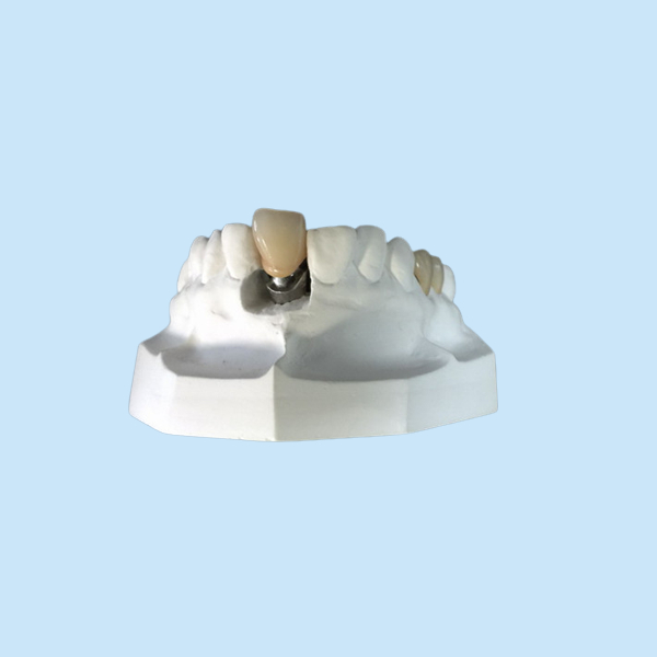 Denture приложения Адвокатуры стабильности изготовленных на заказ локаторов зубного имплантата высокий