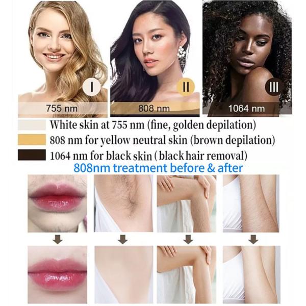 755nm 1064nm 808nm Diode Laser Hair Removal Beauty Machine Professional