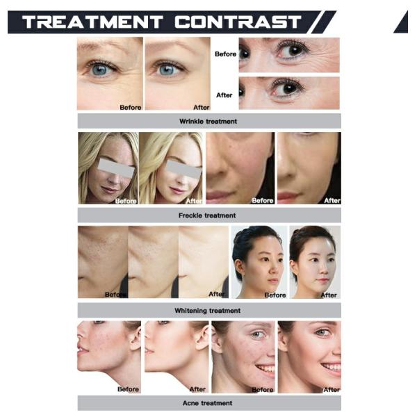 Jet Peel Technology Mesotherapy Device for Multi-Language Skin Care and Resurfacing