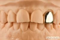 Oro 60K Corona oral metálica resistente a la abrasión Corona dental de cera de fundición
