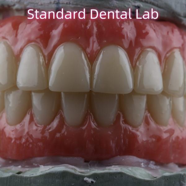 Dental Implant Crown PFZ Porcelain Layered Zirconia Screw Retained With Pink Gum