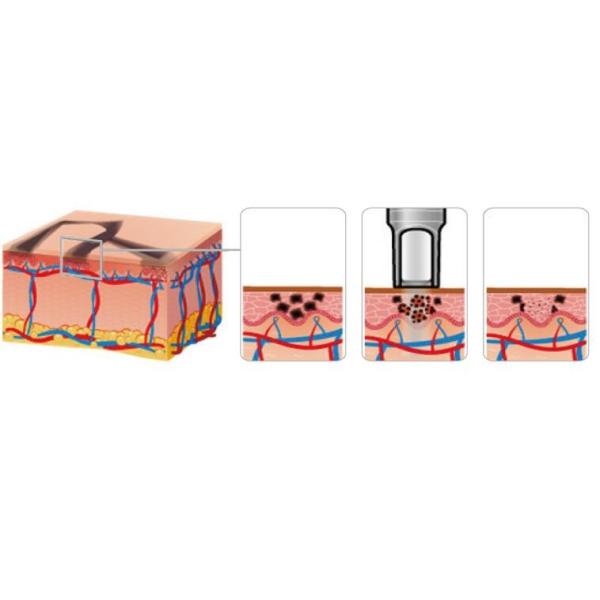 Picosecond Laser Tattoo Removal Machine , Skin Rejuvenation Nd Yag Laser Machine