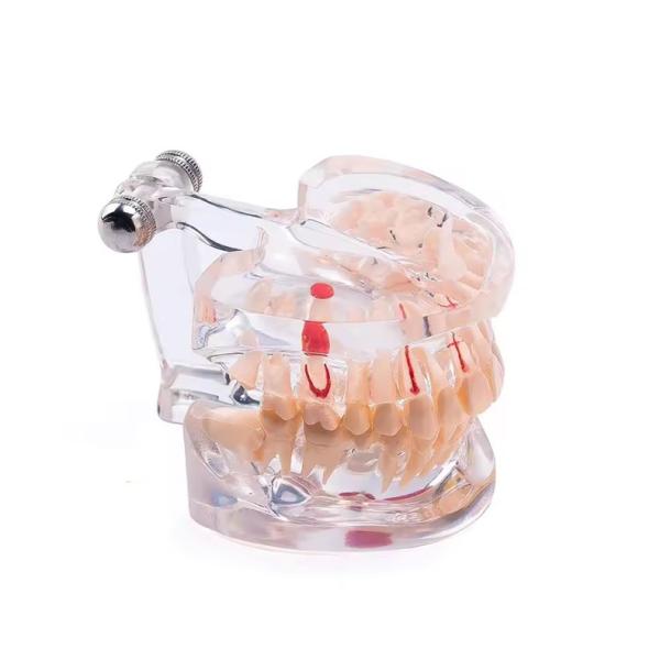 32 Tooth Full Month Implant Disease Teeth Model Clear Design  Dental Pathology Model