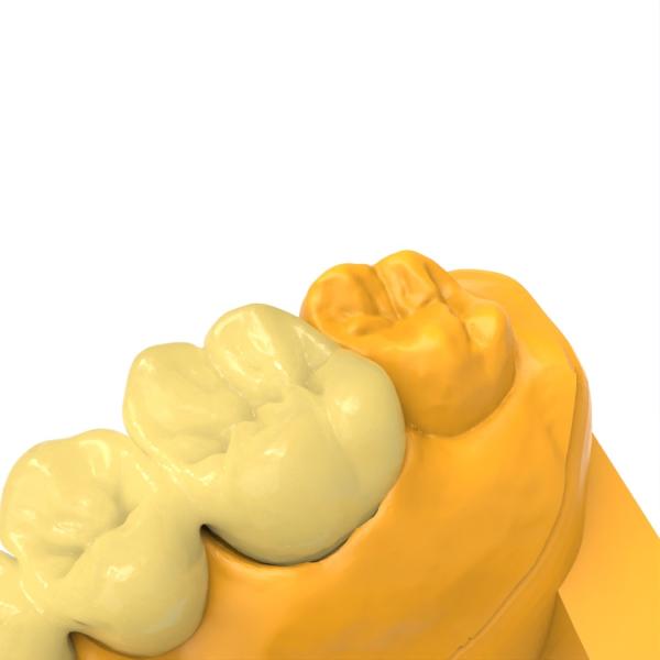 Résine de pont à couronne permanente inodore