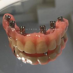 Choose China Dental Implants for Permanent and Reliable Solution to Missing Teeth with Wholesale Prices