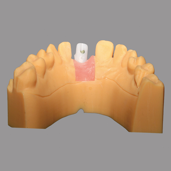 White Custom Zirconia Abutment Natural Looking For Dental Restoration