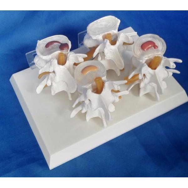 Vertebrae Diseased 4 Stage PVC Human Lumbar Spine Anatomy Model