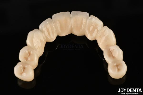 PFM Ceramic Fused To Metal Crown High Biocompatible and Corrosion Resistant