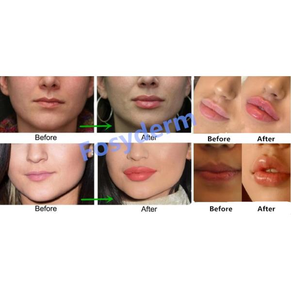 Winkles заполнителя 2ml Juvederm Hyaluronic кисловочная впрыска тела дермальных анти- лицевая