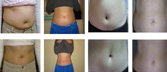 2018 latest medical CE approved far freeze cryolipolysis low price weight loss machine