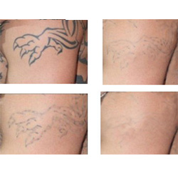 Factory price picosecond laser device tatoo removal acne scars removal skin whitening