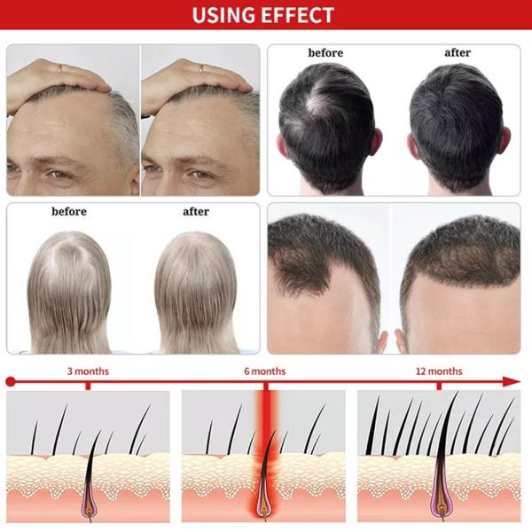 Многофункциональный шлем терапией красного света для роста/облегчения боли волос