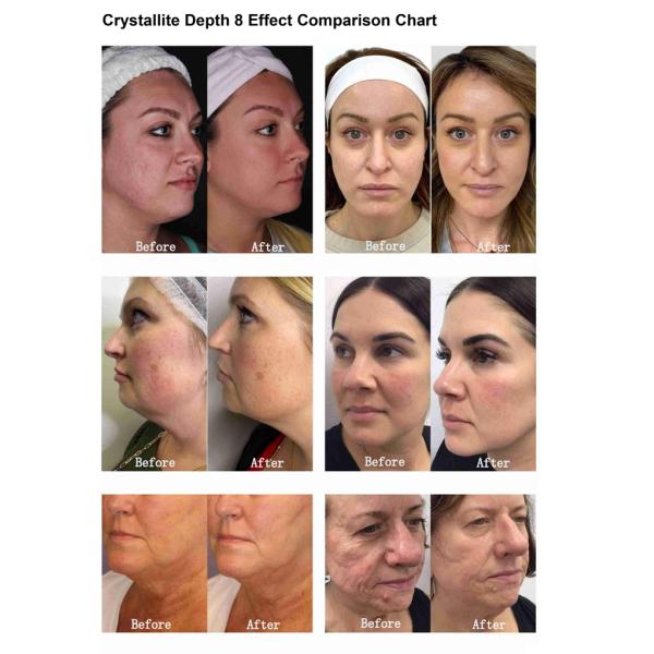 5 in 1 Crystallite Morpheus8 Needling RF HIFU Machine Multi row ICE HIFU 12D Vmax Cooling HIFU Fce Lift Skin Tightening