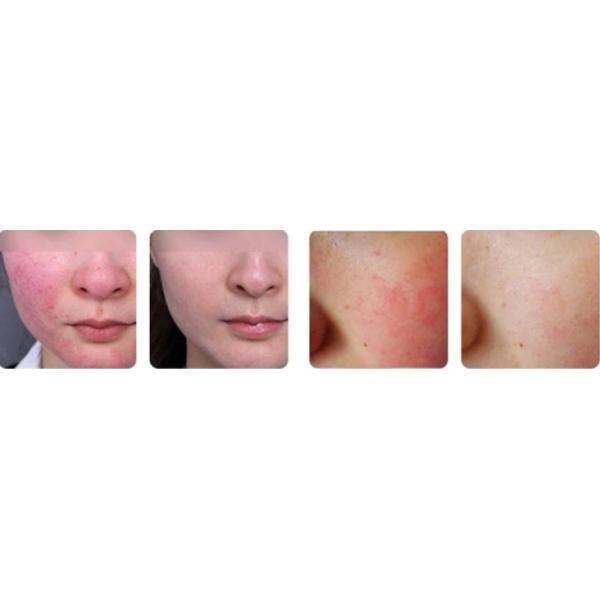 GentleYAG Laser Hair Removal: Precisely Target Individual Hair Follicles With 755nm And 1064nmLong Pulse Laser Nd Yag